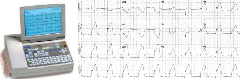 Exemple d'appareil ECG et tracé 12-dérivations enregistré 
